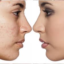 Acne scars in chandigarh