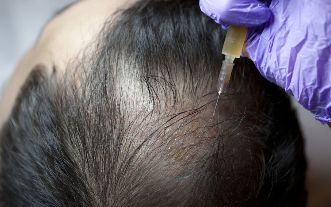 Get An Outstanding Hair Thinning Treatment In Chandigarh By Visiting Us