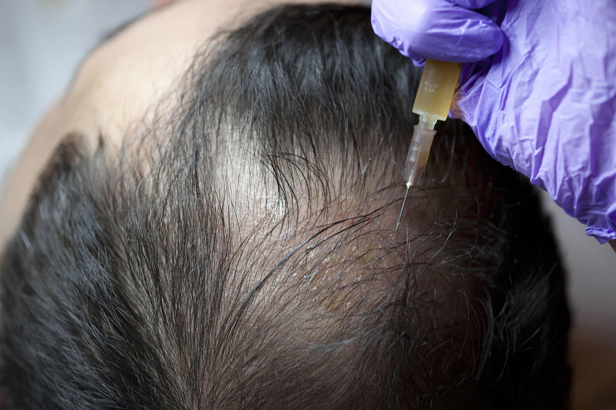 Hair Thinning Treatment In Chandigarh