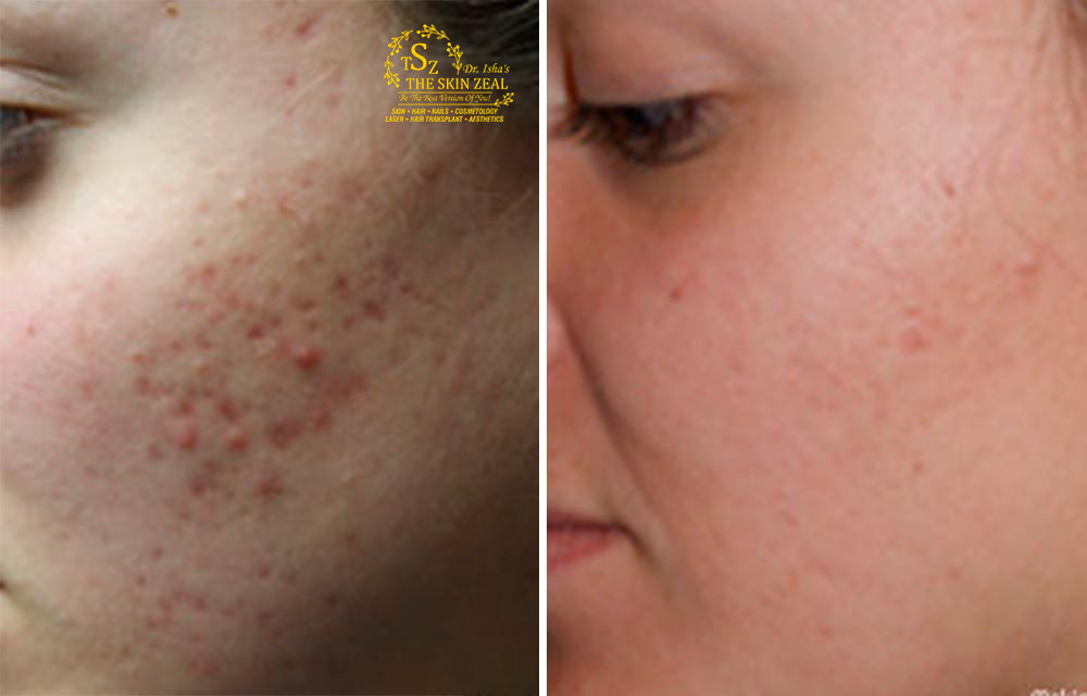 Experience The Most Wonderful Face Peeling Treatment In Chandigarh With Us
