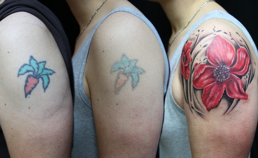 Enjoy The Best And Most Satisfying Laser Tattoo Removal Service Here